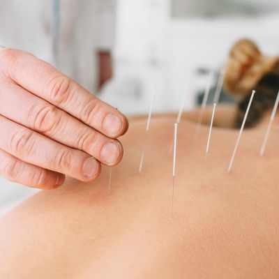 Acupuncture